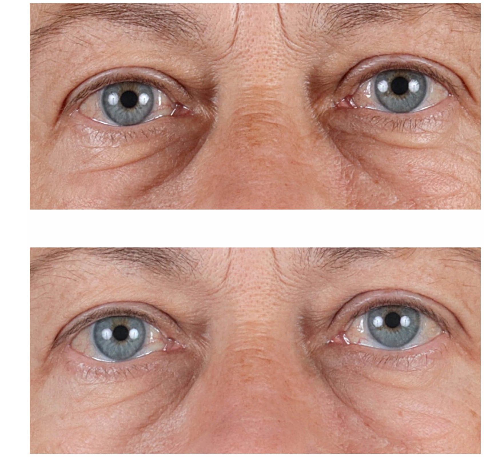 Fotos de cerca de los ojos después del uso de Perricone MD High Potency Hyaluronic Intensive Hydrating Serum con DMAE. Muestra piel con menos líneas de expresión.