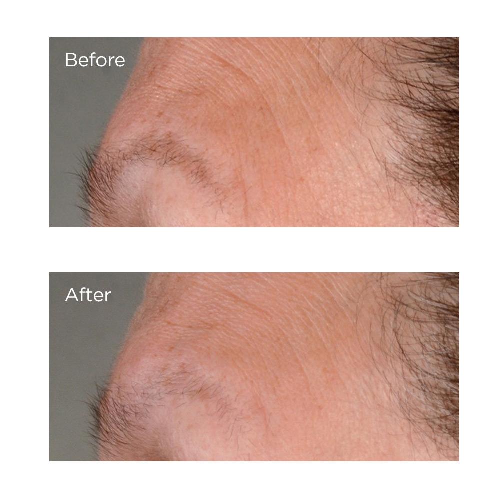 Primer plano de una frente con menos arrugas después de usar Perricone MD High Potency Growth Factor Firming & Lifting Serum.