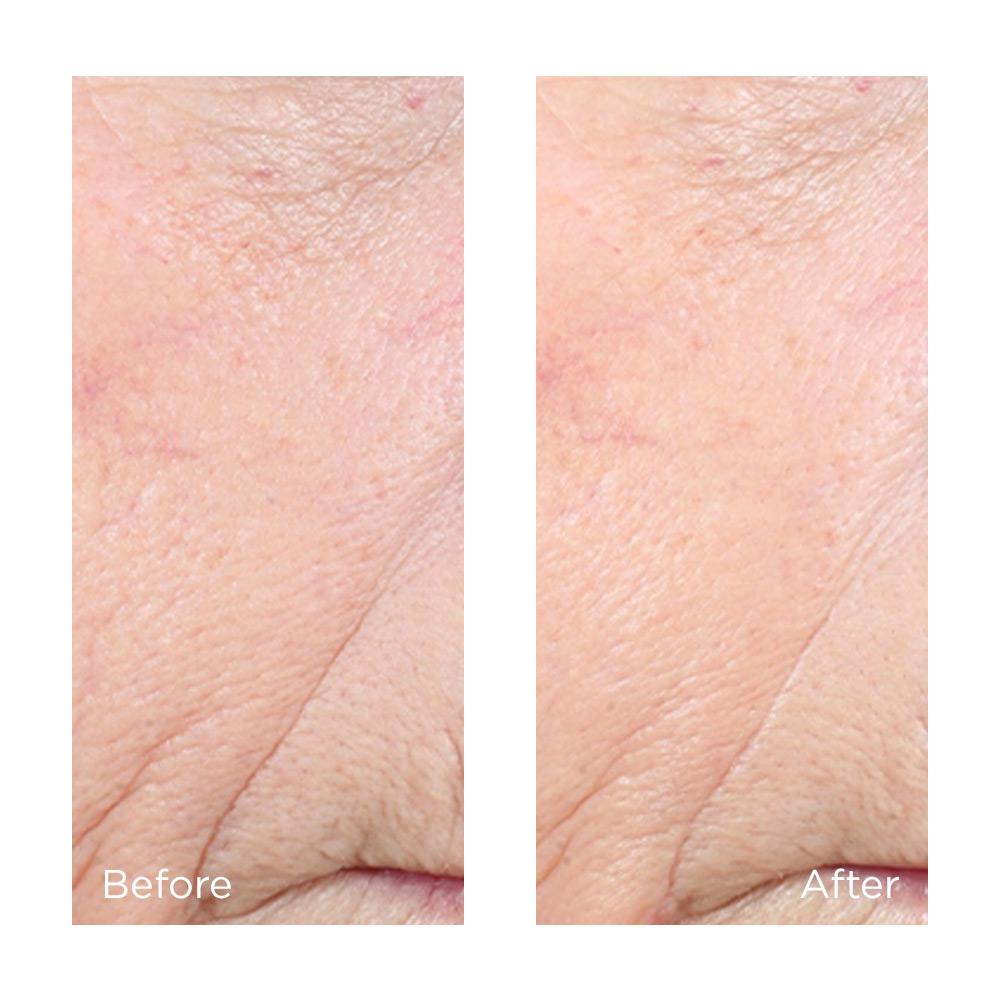 Primer plano de arrugas reducidas y una piel más suave luego de usar Perricone MD Vitamin C Ester CCC+ Ferulic 20%.