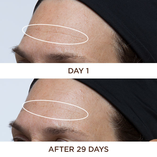 Antes y después de 29 días de uso de Perricone MD Cold Plasma Plus+ Face, muestra menos líneas en la frente