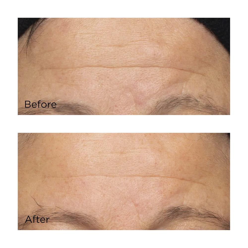 Las fotos de antes y después muestran una frente rejuvenecida y más suave gracias a Perricone MD Cold Plasma Plus+ The Intensive Hydrating Complex.