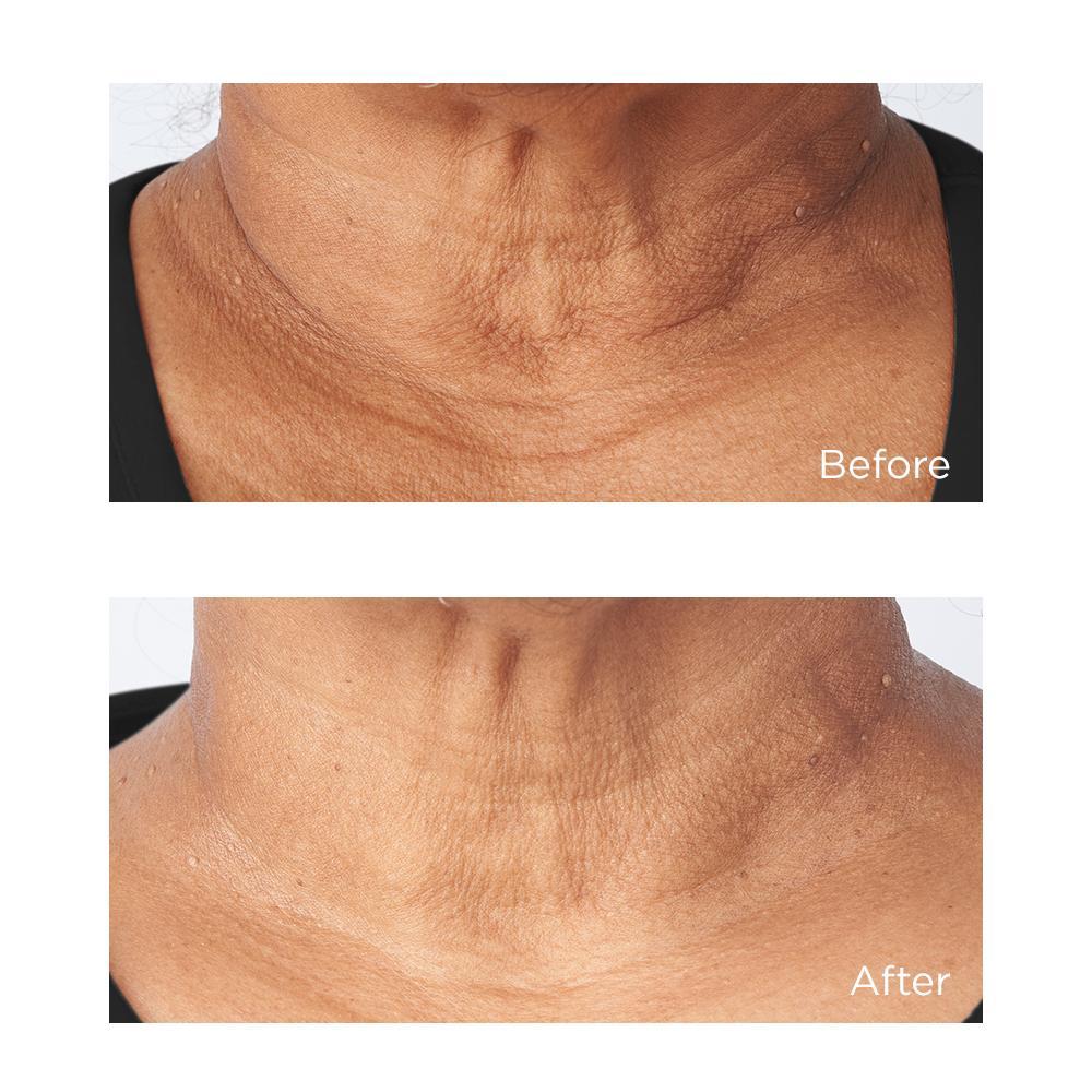 Primer plano muestra el antes y después del uso de Perricone MD Cold Plasma Plus+ Sub-D/Neck con piel más firme.