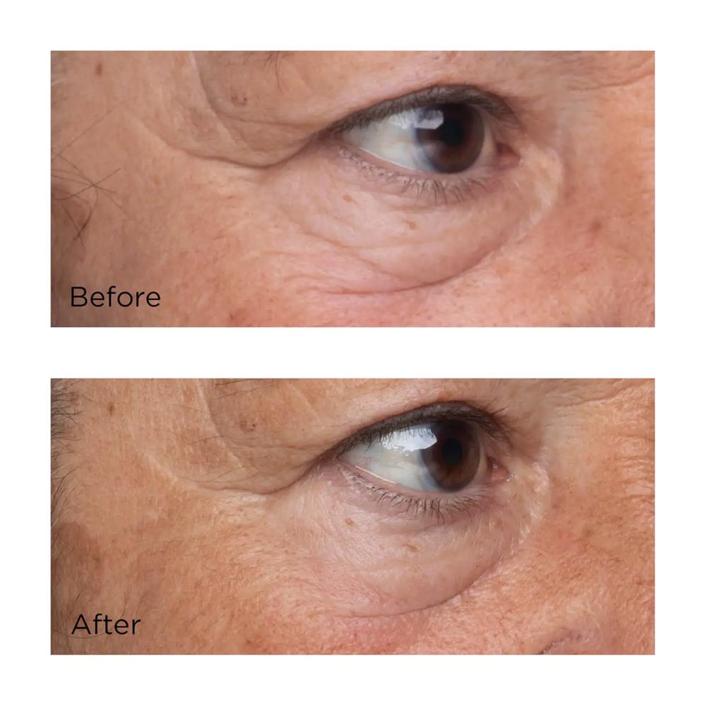 Primer plano del área de los ojos antes y después de aplicar Perricone MD High Potency Eye Serum, muestra una piel con menos arrugas y líneas de expresión.