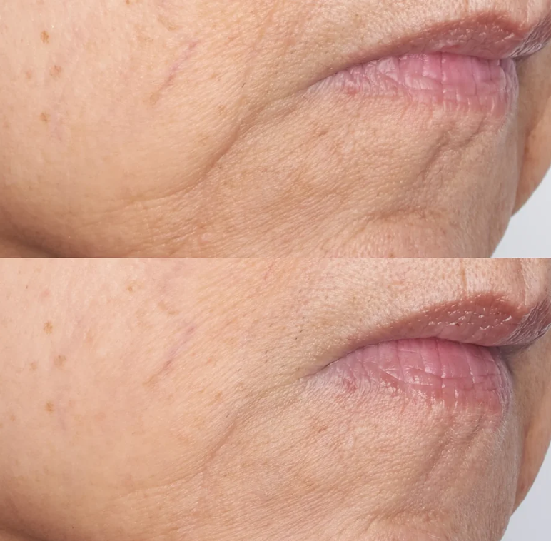 Perricone MD  Cold Plasma Plus+ The Intensive Gel Mask