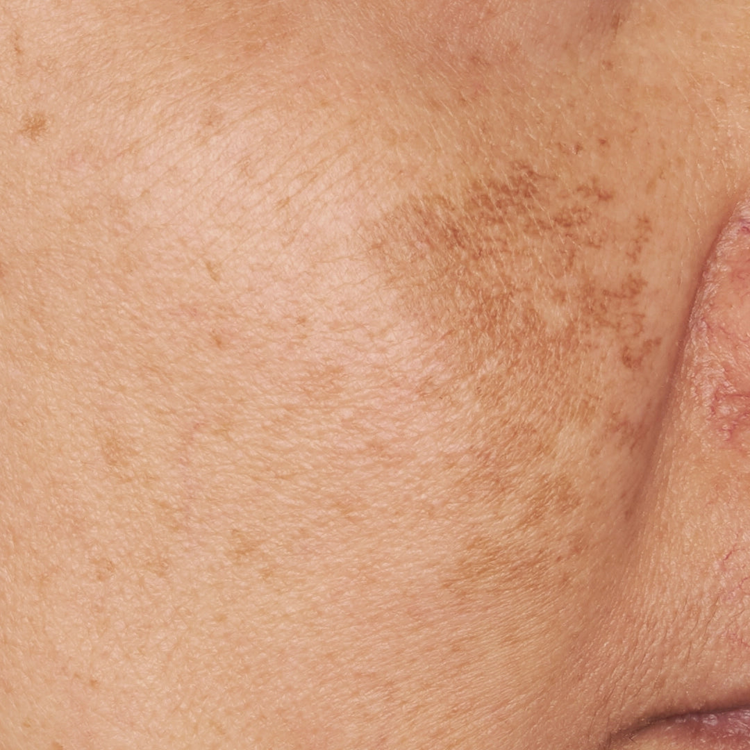 Primer plano de una mujer con manchas visibles en la piel, representando la rutina para reducir y prevenir manchas oscuras.