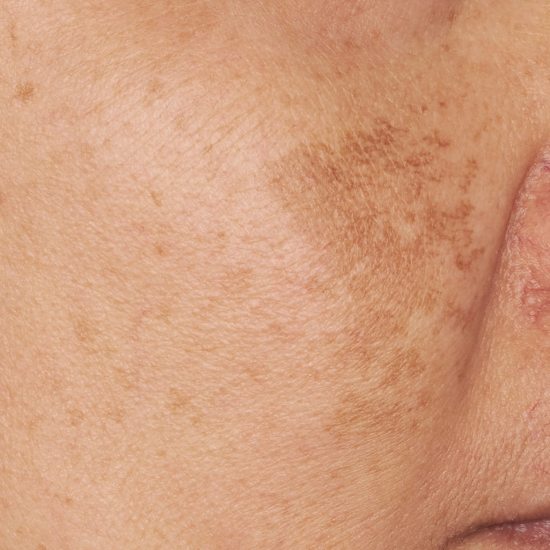 Rutina para tratar las manchas de la piel