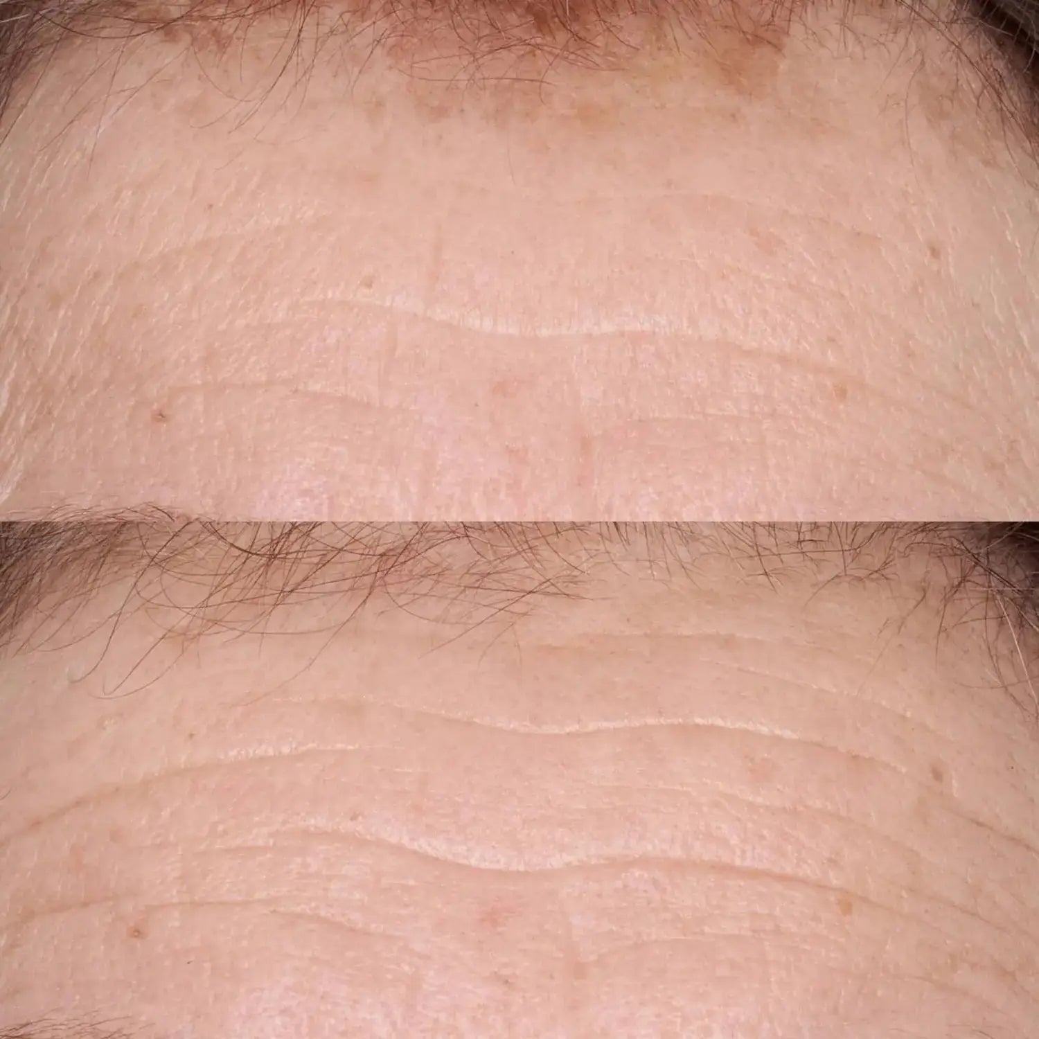 Resultados antes y después del uso de suero para piel sensible Perricone MD Hypoallergenic Smoothing Restorative Serum