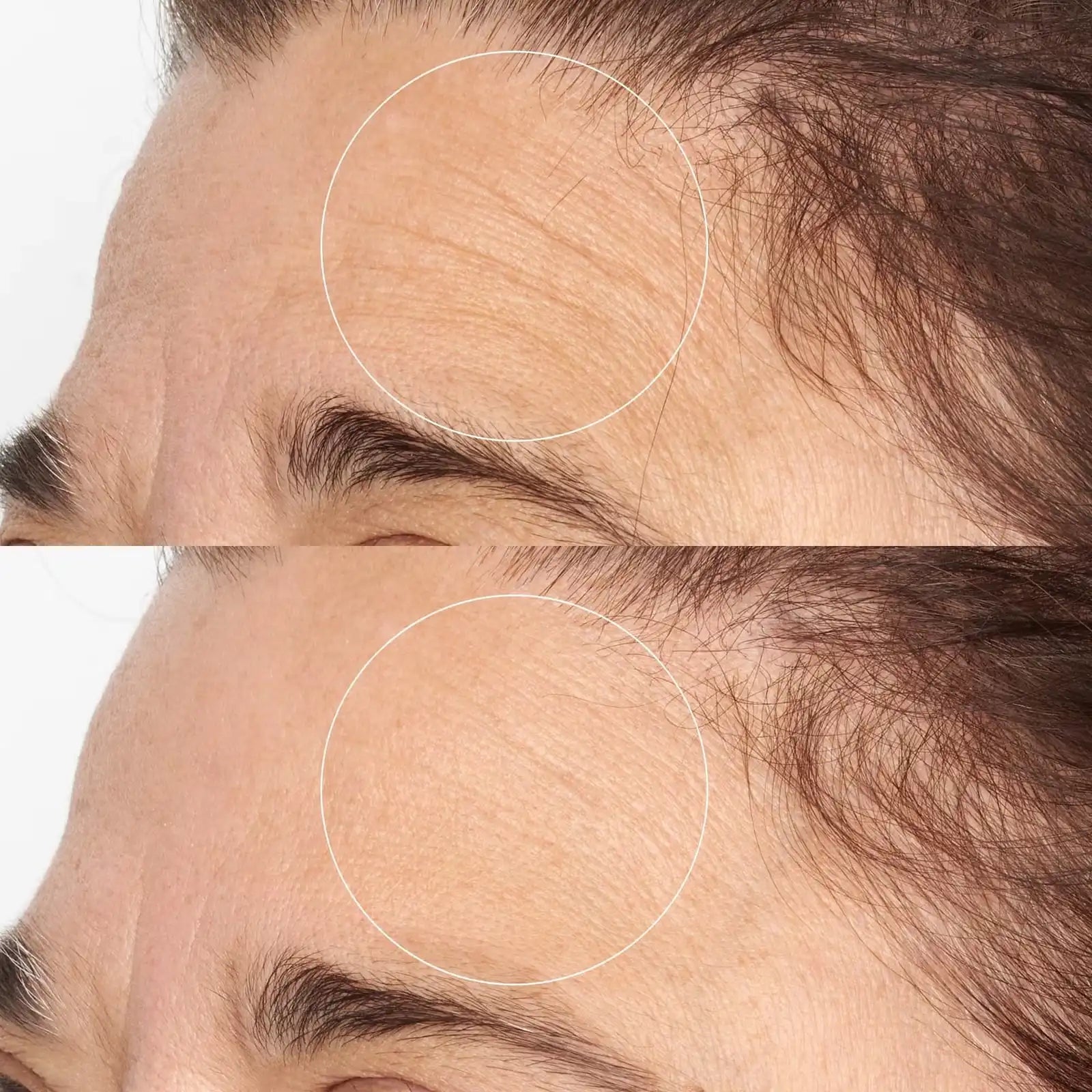 Comparación antes y después en la frente mostrando reducción visible de líneas finas y mejora de la textura.