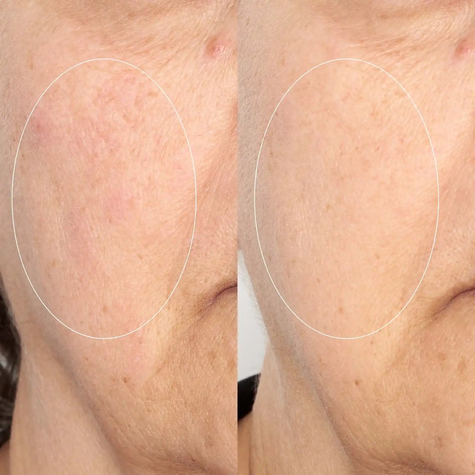 Comparación antes y después en la zona de la mejilla mostrando piel más uniforme y textura más lisa tras el uso del sérum.