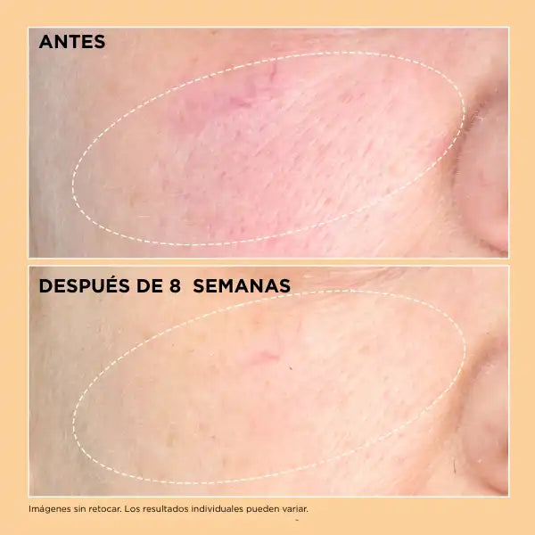 Resultado clínico antes y después tras 8 semanas mostrando mejora visible de firmeza y textura de la piel.