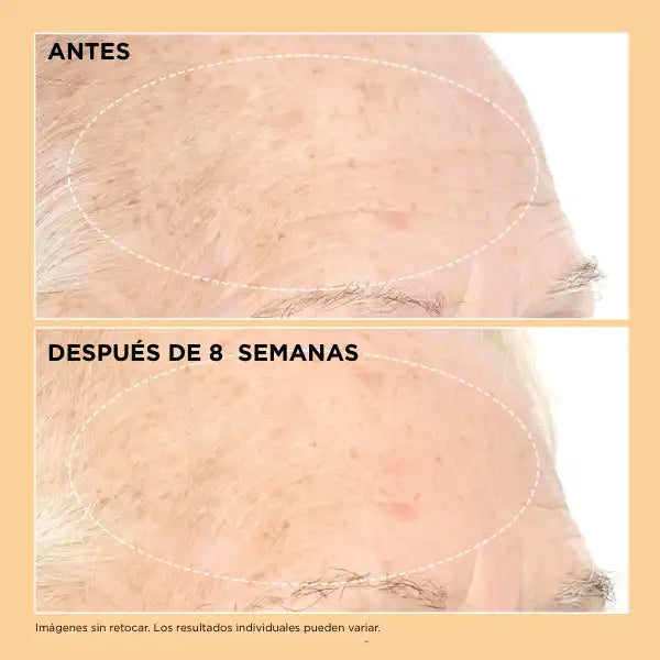 Comparativa clínica antes y después con reducción visible de arrugas y mejora de la densidad cutánea.