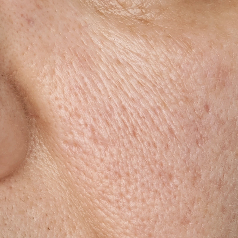 Rutina para tratar el poro dilatado