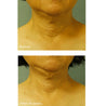 Cold Plasma Plus+ Neck & Chest SPF25